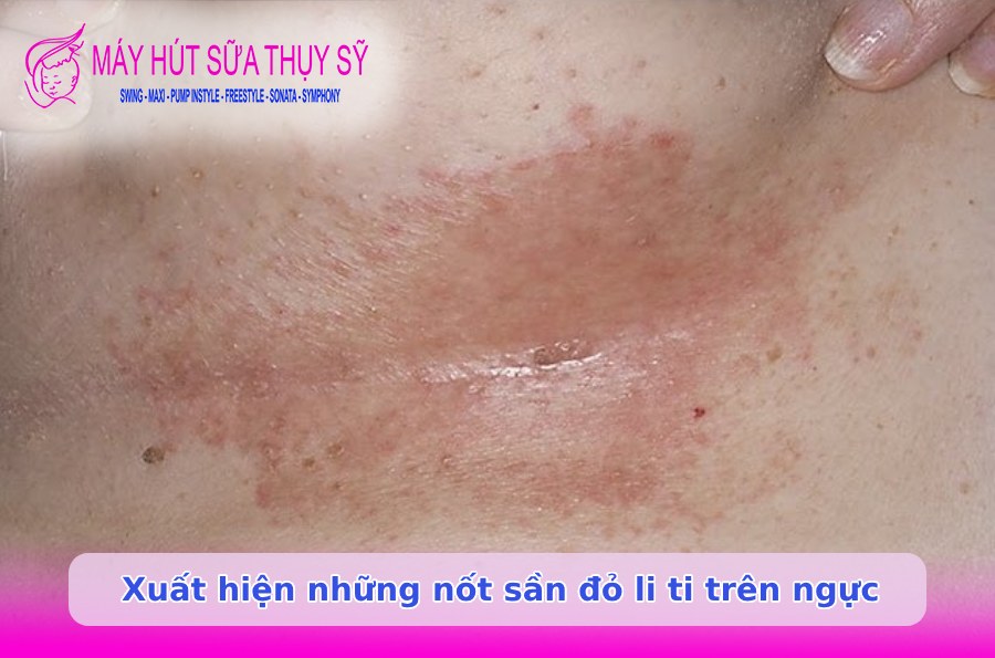 Mất sữa một bên xuất hiện những nốt sần đỏ li ti