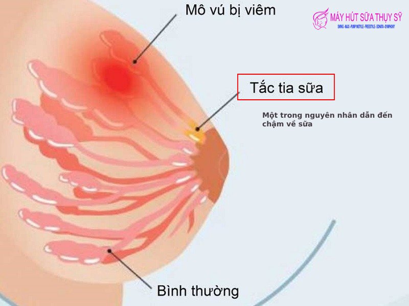 Làm sao để sữa về nhanh sau mỗi cữ bú