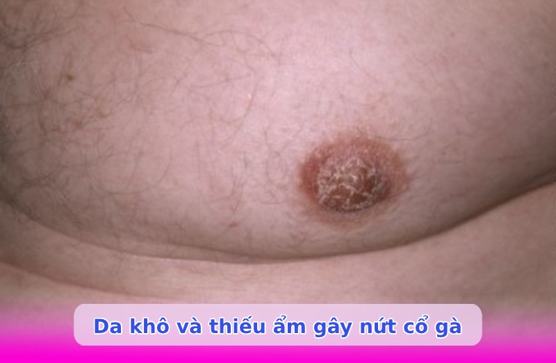 Nứt cổ gà khi hút sữa