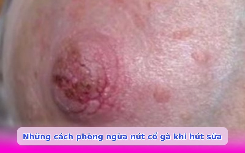 Nứt cổ gà khi hút sữa
