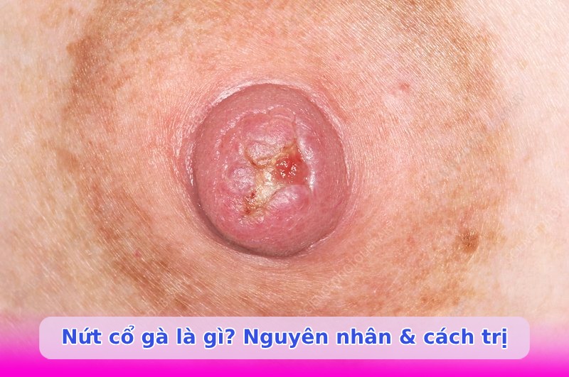Nứt cổ gà khi hút sữa