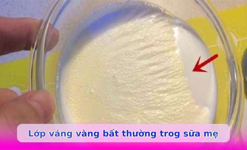 Sữa mẹ có lớp váng màu vàng