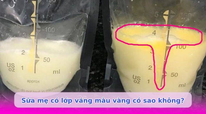 Sữa mẹ có lớp váng màu vàng